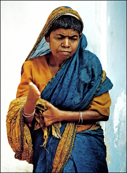 Leprosy Patient - Bengal - Travels Abroad